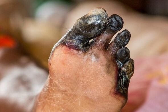 Gangrena de los dedos de los pies en el diat